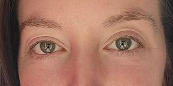 Real Patient Before and After Blepharoplasty at Clearview Dermatology