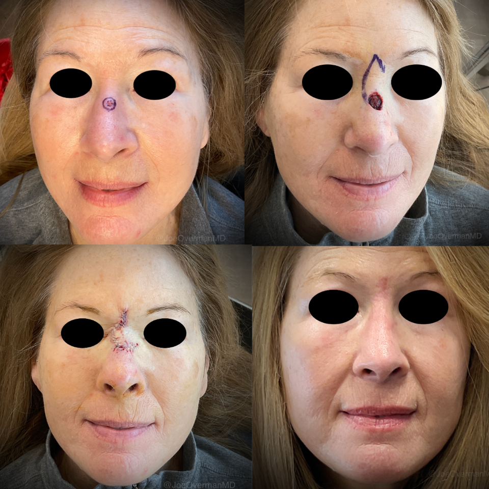 four pictures of a woman 's face before and after surgery
