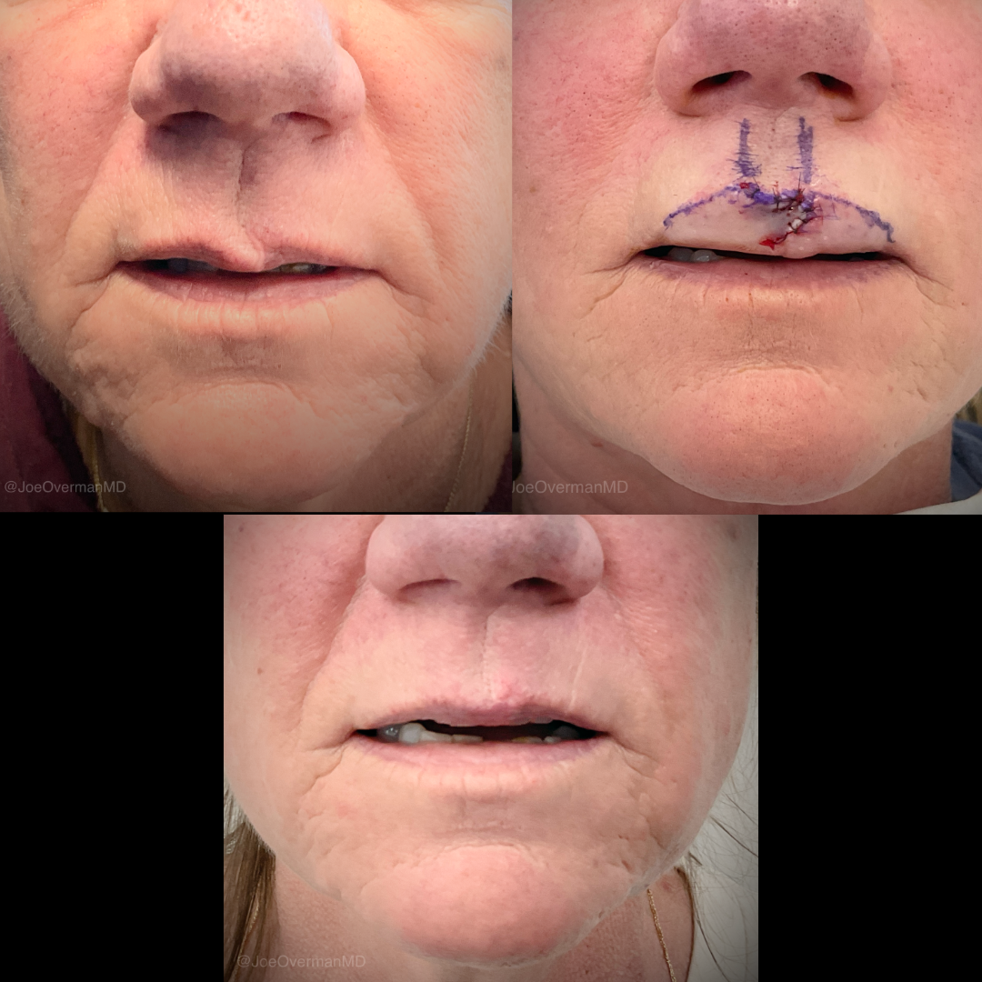 real patient before and after scar revision in arvada co at Clearview dermatology by Dr. Joe Overman