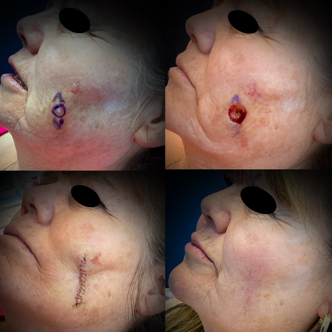 cheek surgery before and after