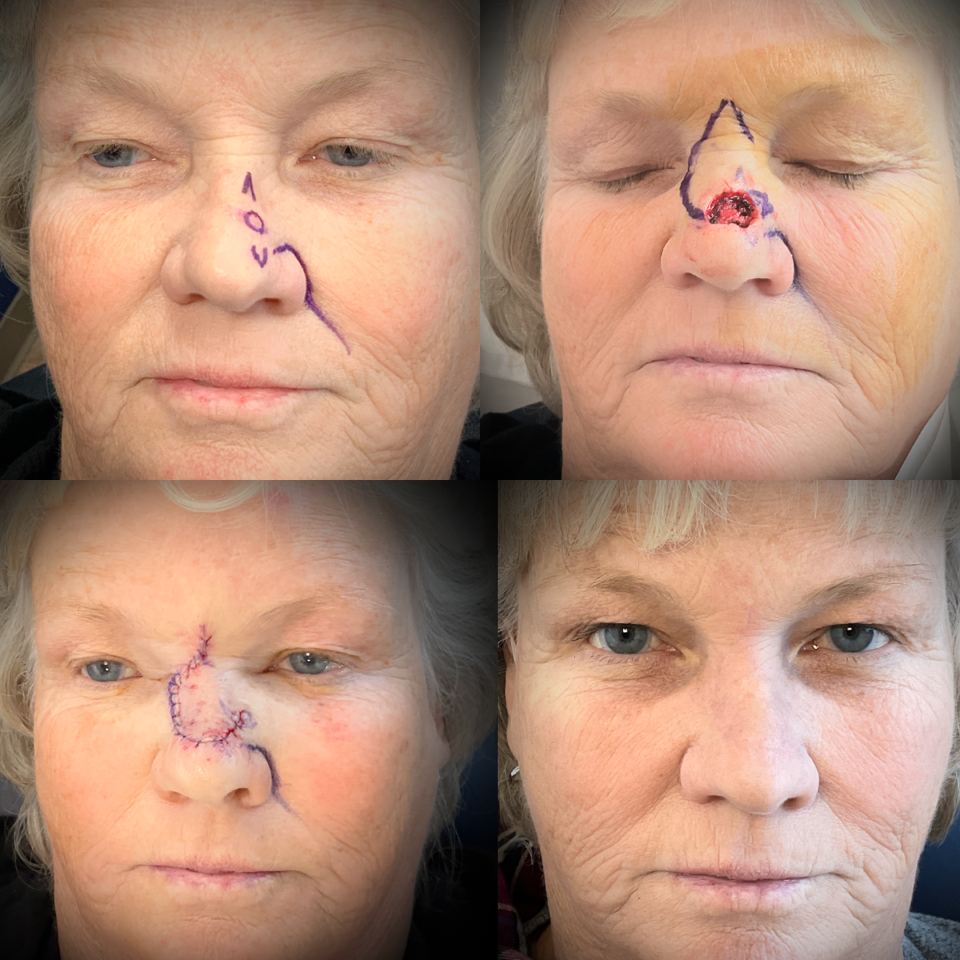A collage of four pictures of a woman 's face before and after surgery.