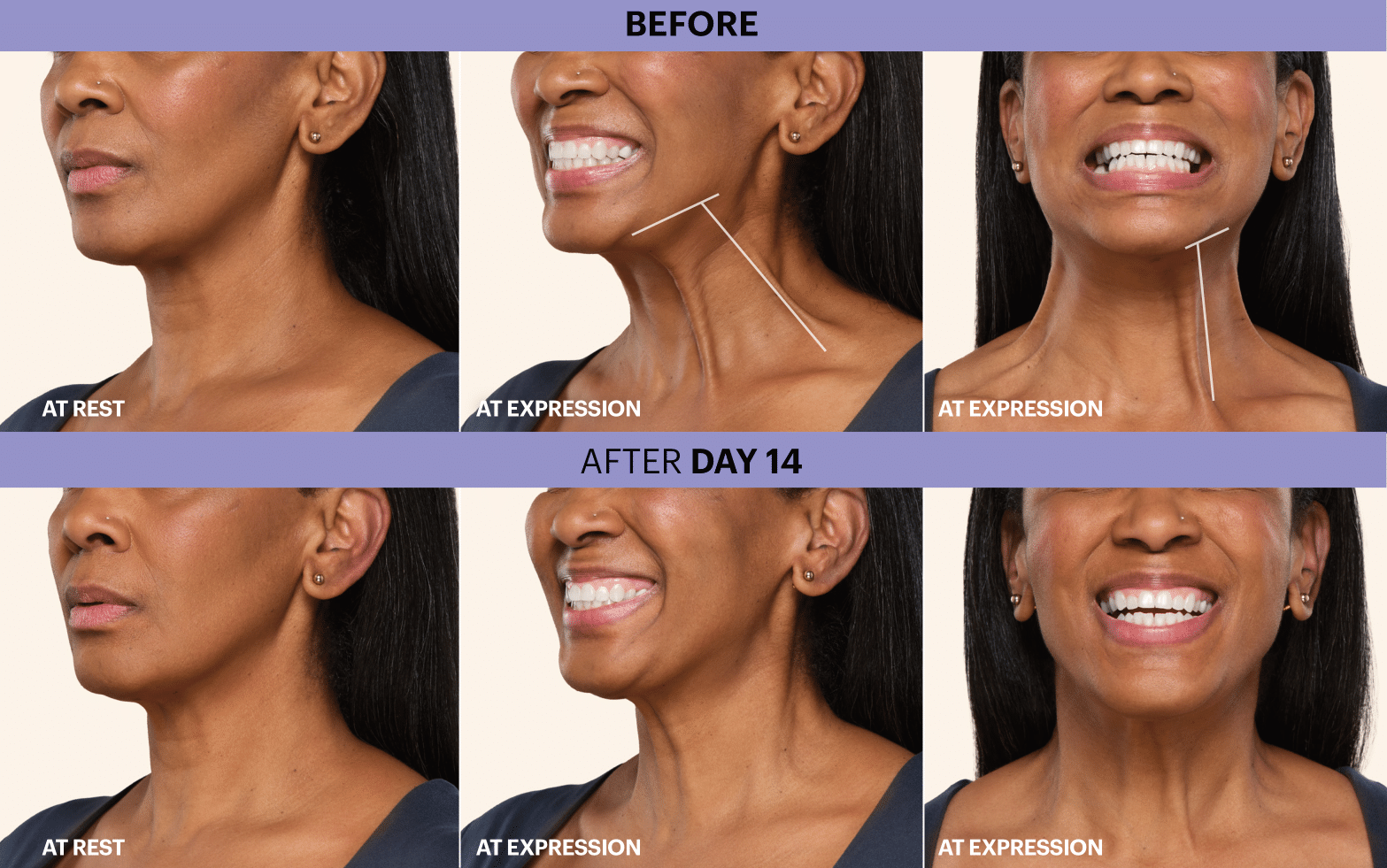 Patient Before and After Botox Cosmetic Treatment. at rest and at expression before, 7 days after, and 14 days after treatment