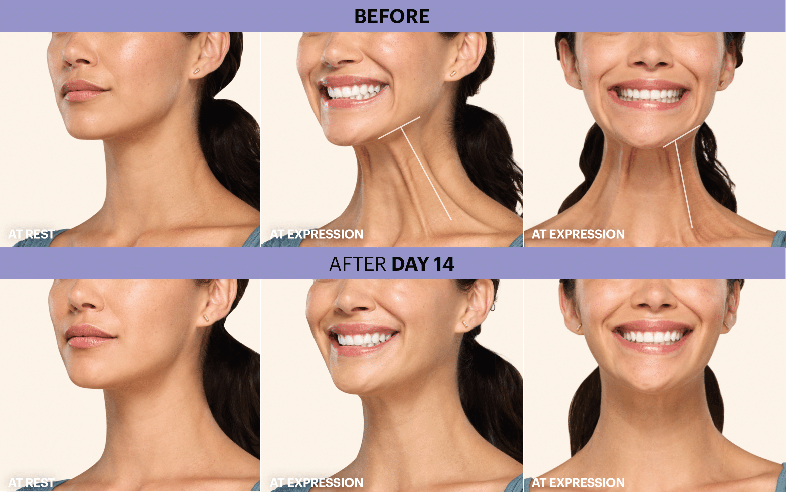 Patient Before and After Botox Cosmetic Treatment. at rest and at expression before, 7 days after, and 14 days after treatment