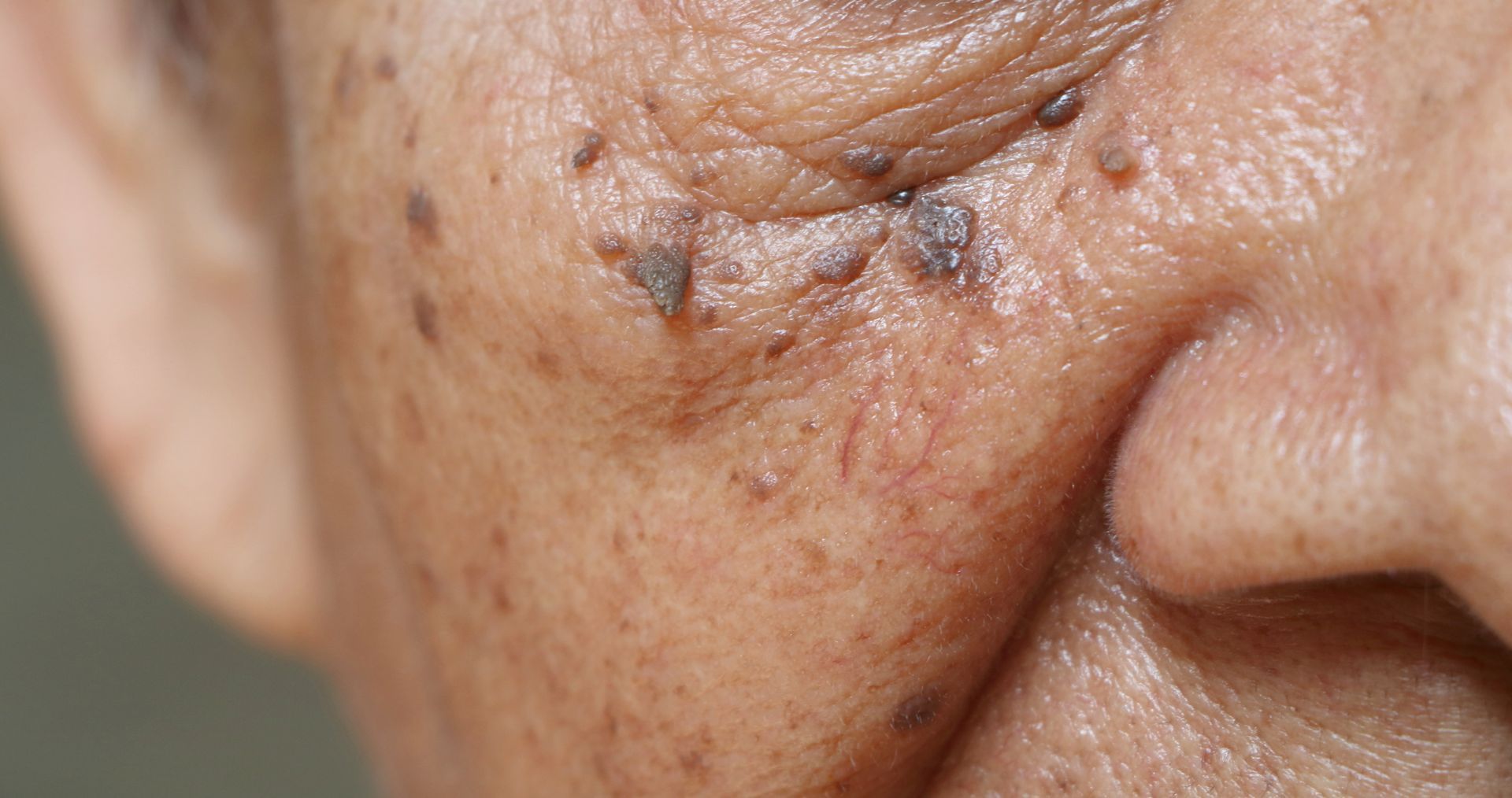Spots below the Eye