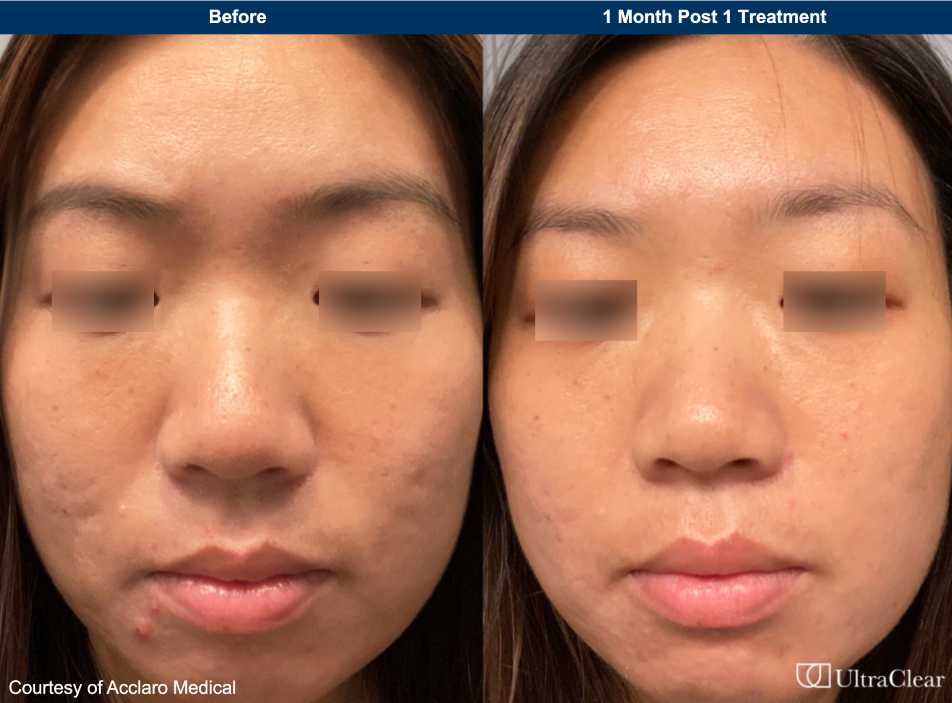 A before and after photo of a woman 's face during ultra clear laser procedure
