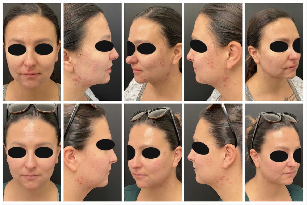 patient at clearview dermatology before and after chemical peel