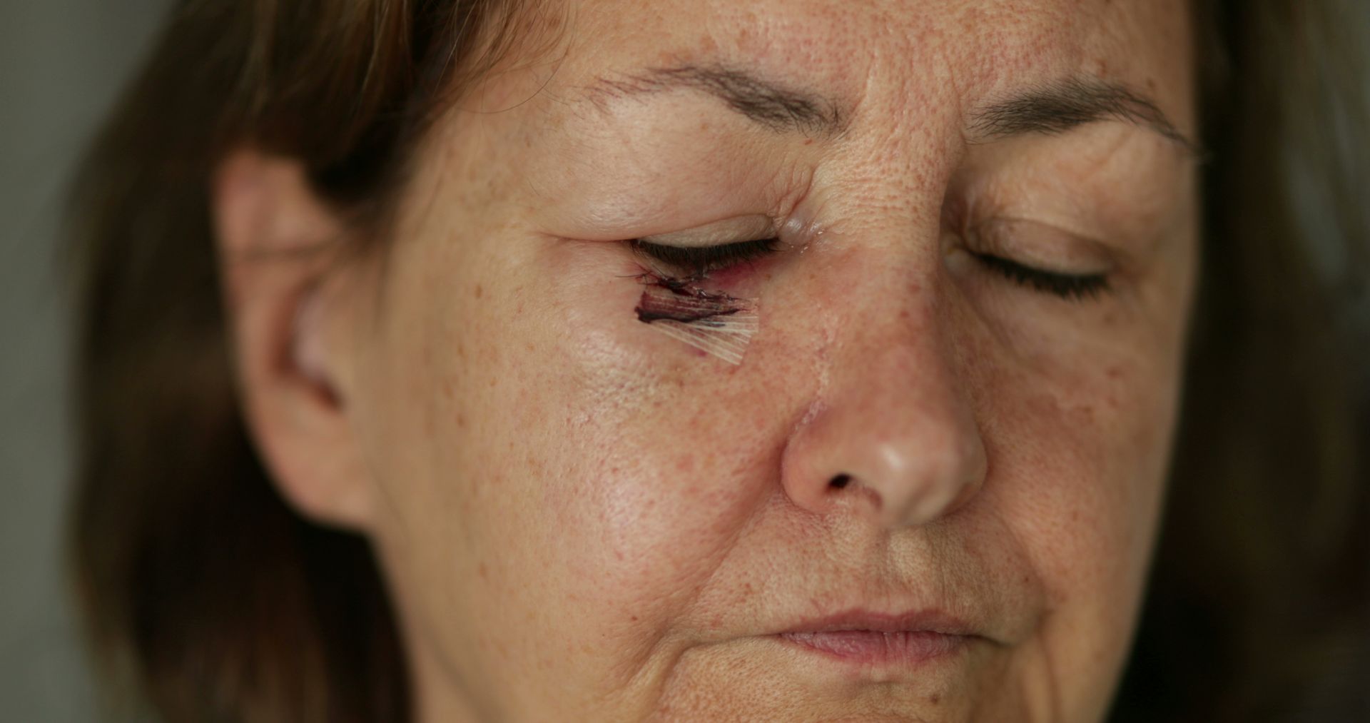 mohs surgery patient - close up of facial scarring - skin cancer surgery - clearview dermatology 