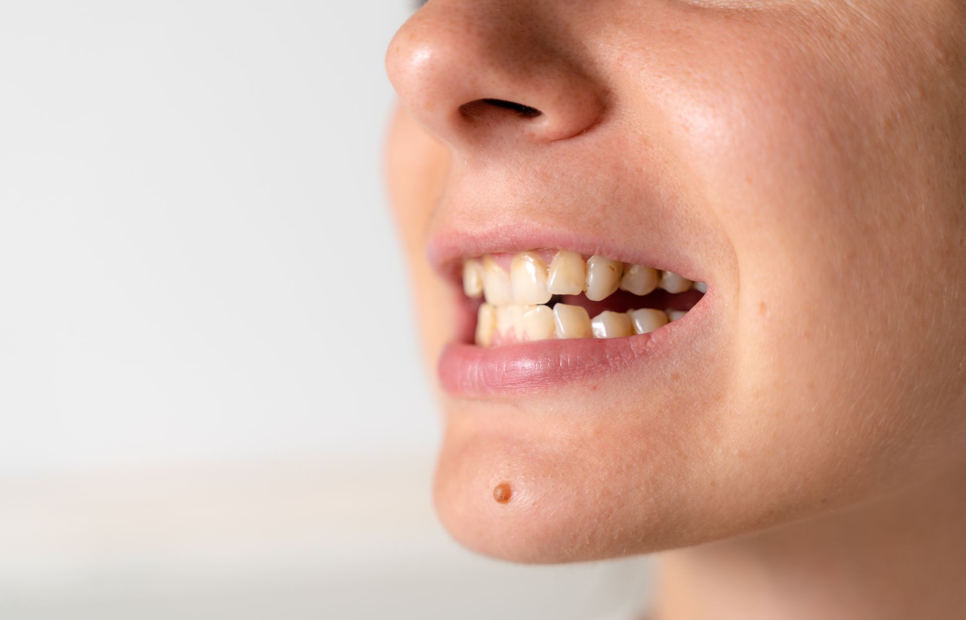 woman with tooth stains
