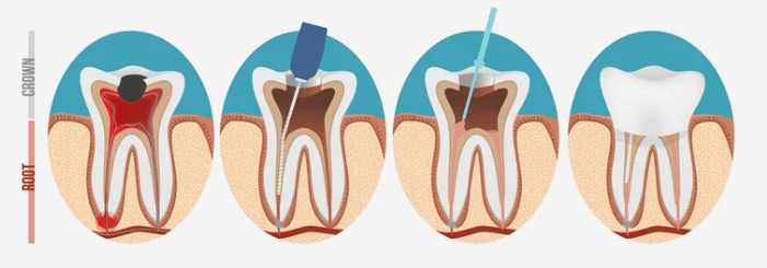 the process of a root canal treatment