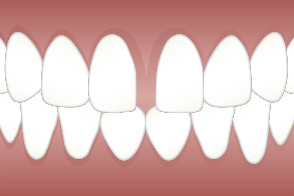 Gum Disease Causes Gaps Between Teeth