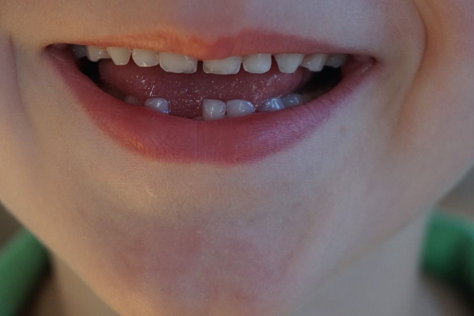 a child with gapped teeth