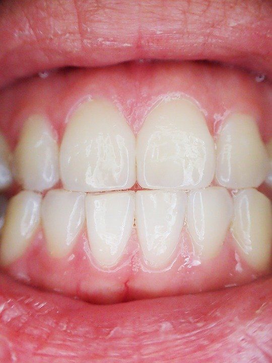 Teeth grinding symptoms causes and treatment