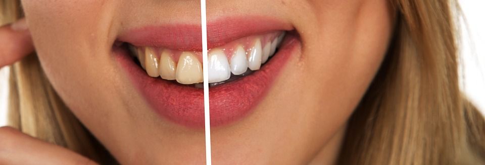 tooth whitening of yellow teeth before and after