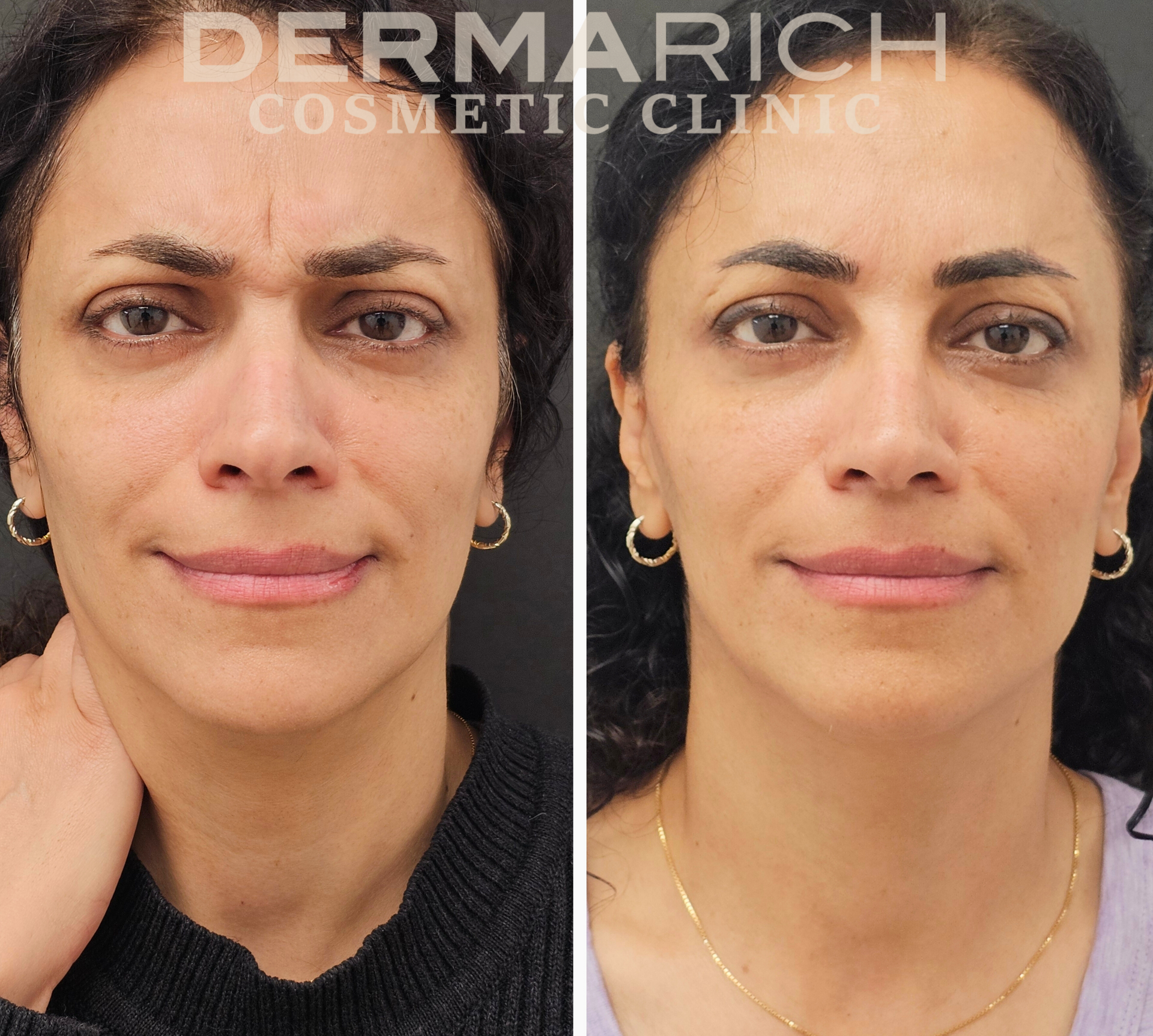 before and after of a middle age lady after botox treatment