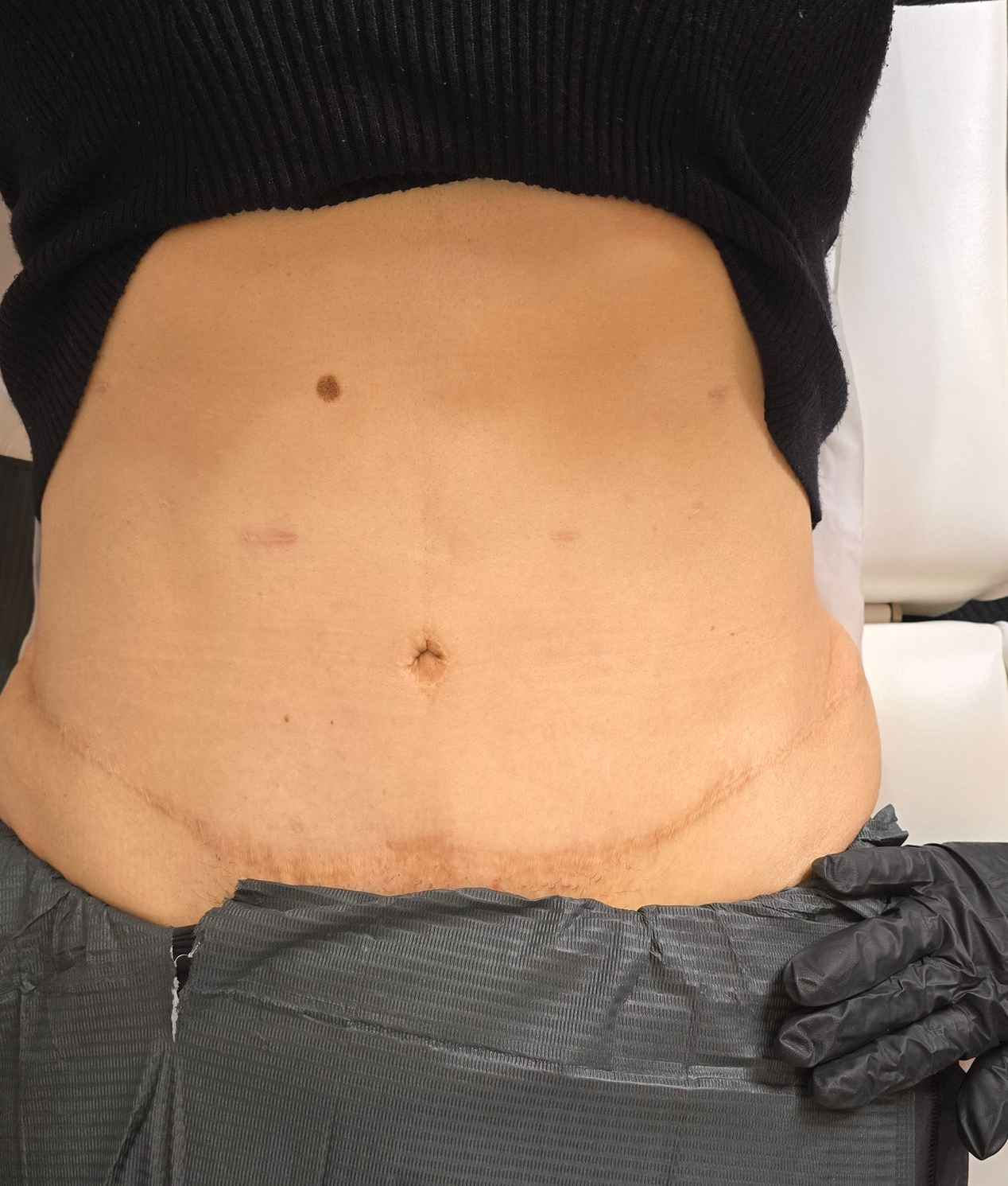 A woman with post pregnancy concerns and tummy tuck scar getting treatment to remove the scar mark.
