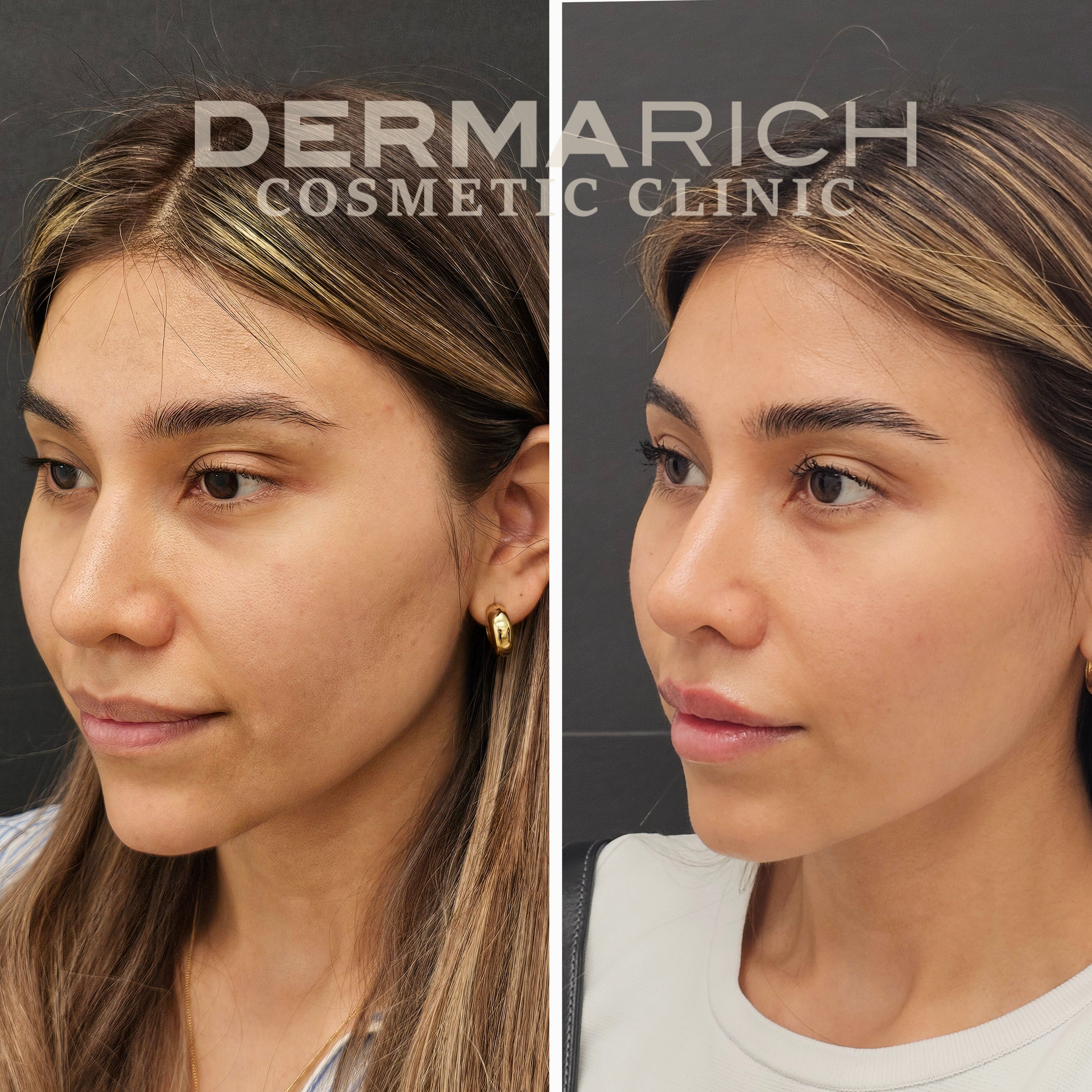 A before and after photo of a woman 's face from dermarich cosmetic clinic