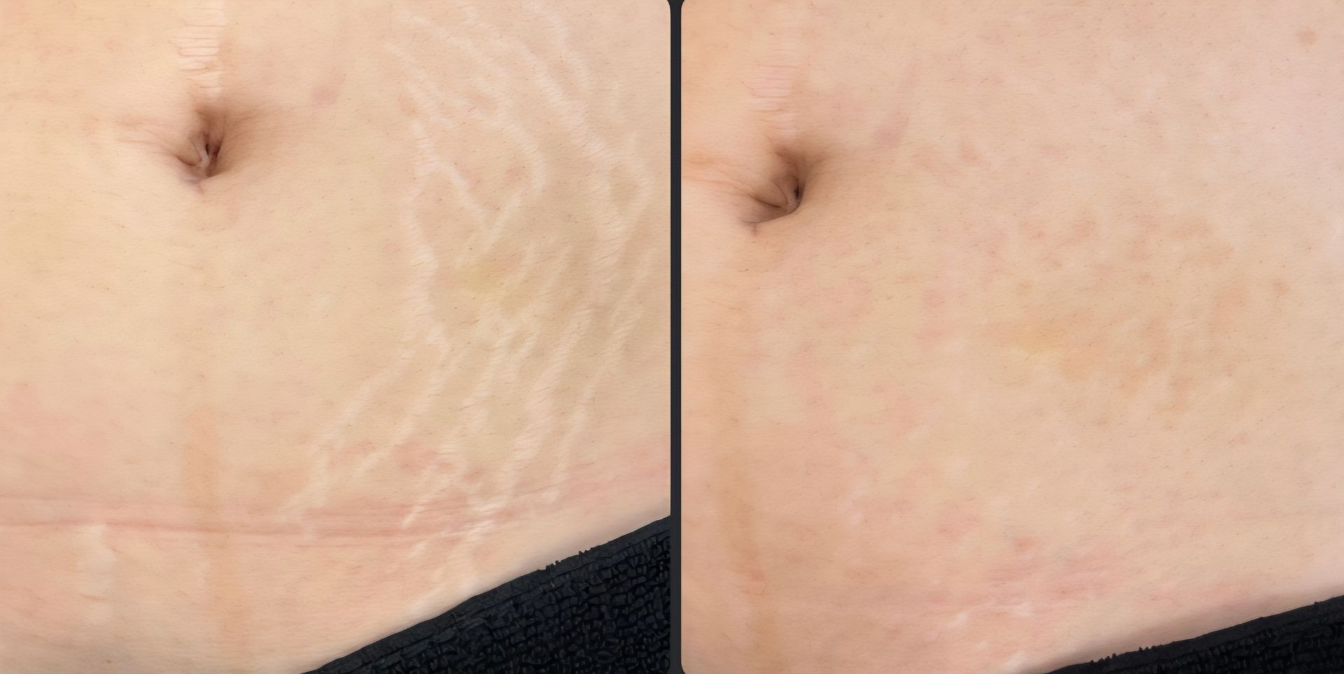post pregnancy stretch mark removed by nue conceal