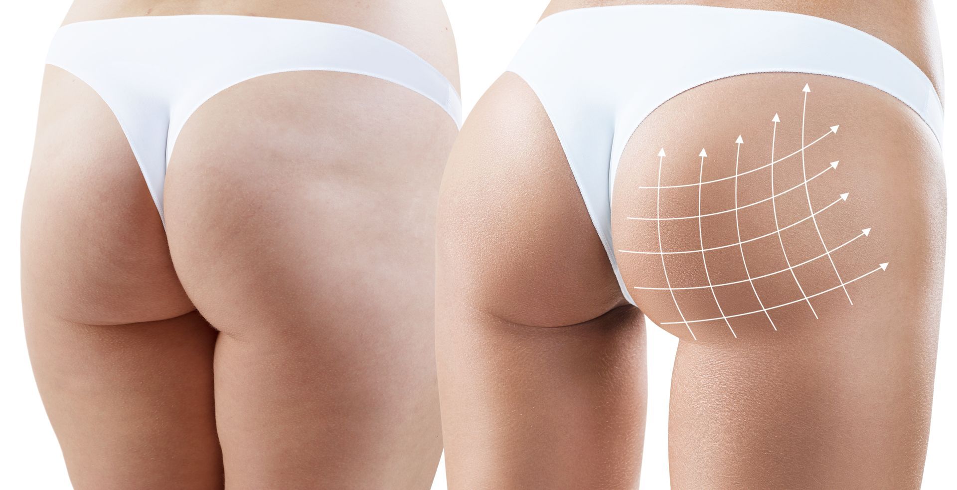 Comparisons of two butts before and after butt lift