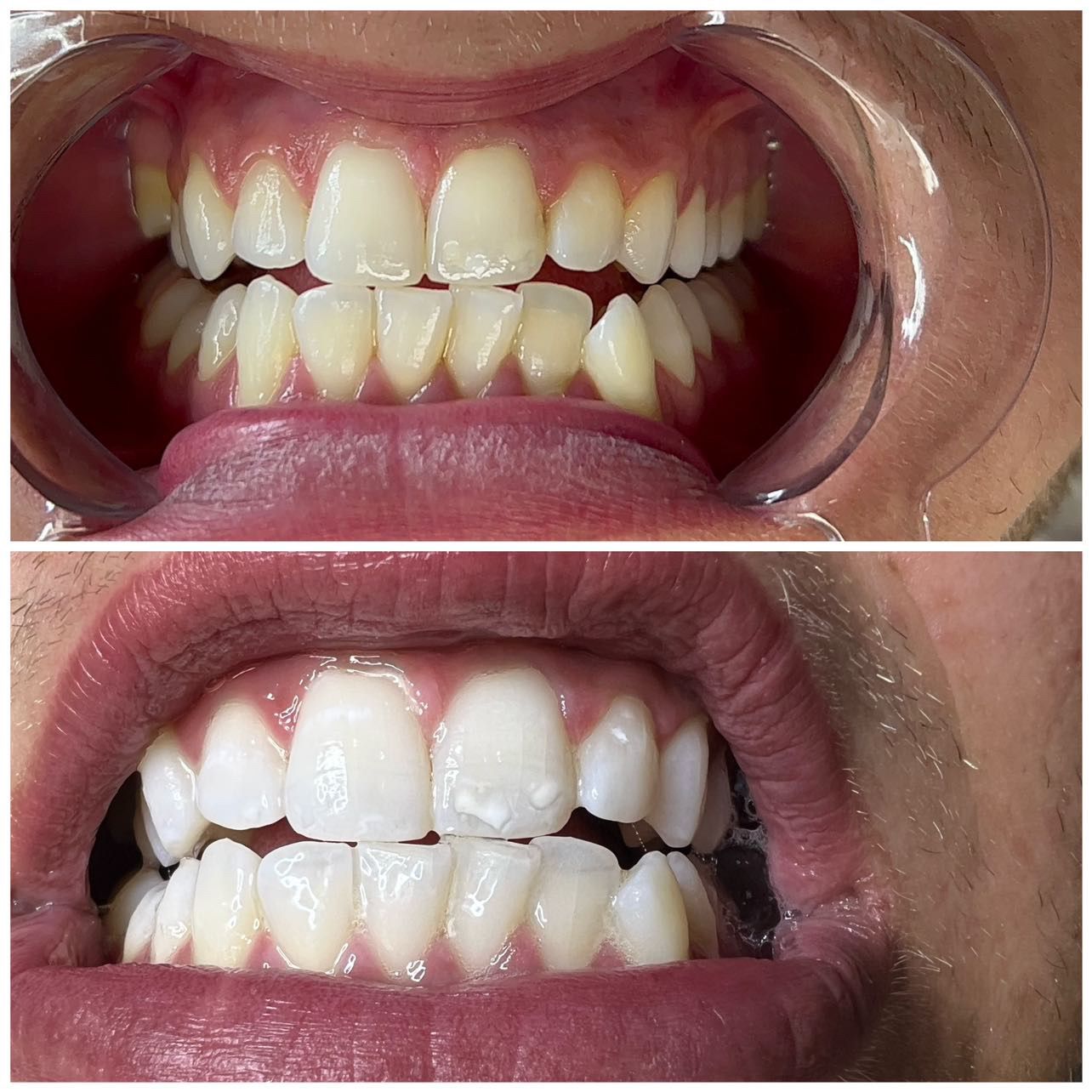 Before-and-after comparison of teeth whitening. Top: yellow teeth. Bottom: significantly whiter teeth.