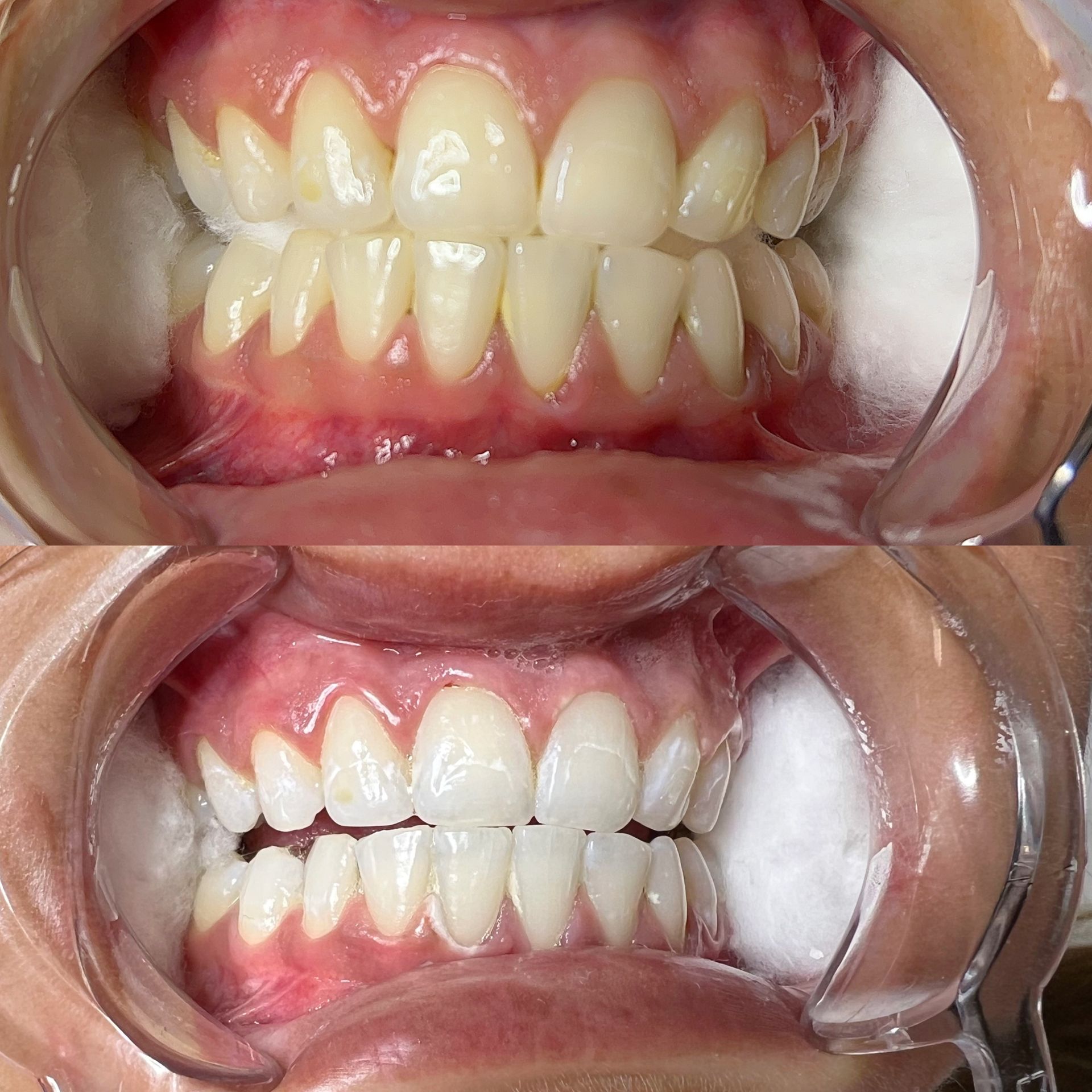 Top: Yellowish teeth. Bottom: Whitened teeth. Both with cheek retractors and pink gums.