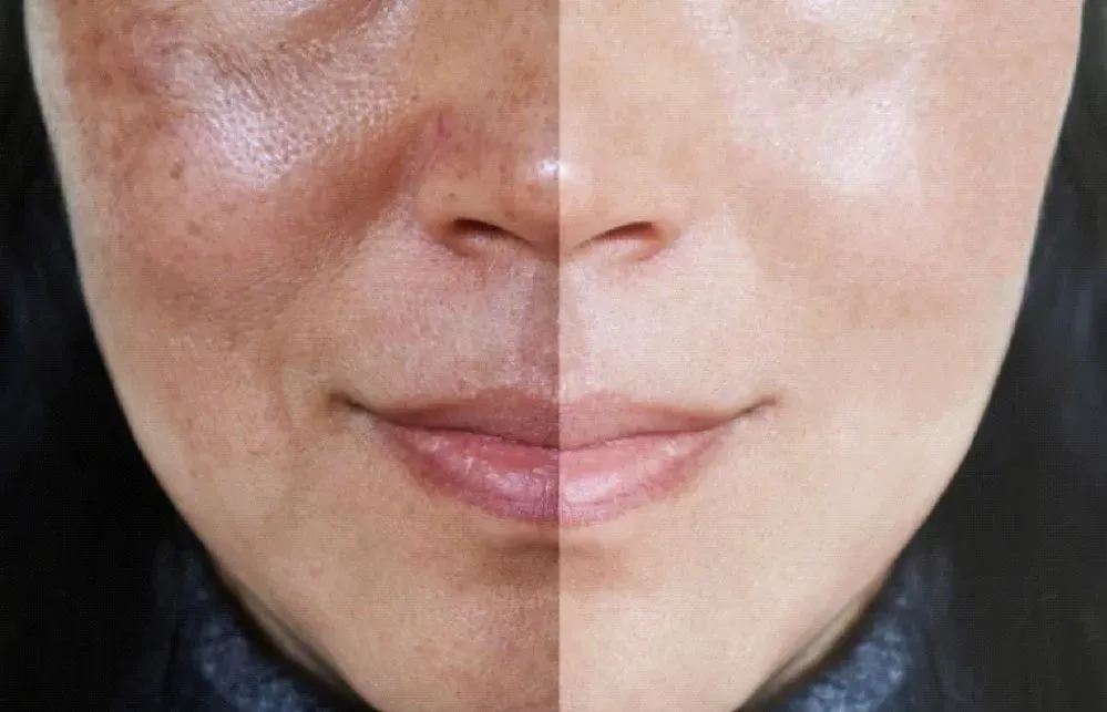 Half face showing skin with dark spots and uneven tone, the other half with clear, even skin.