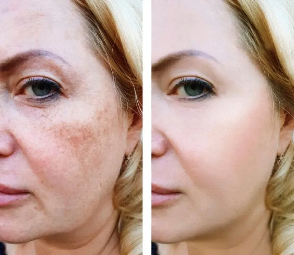 Before and after photo of woman's face; first half showing age spots, second half showing smoother, even-toned skin.