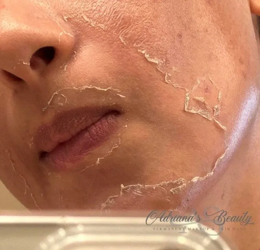 Close-up of a person's face, skin peeling after a chemical peel treatment.
