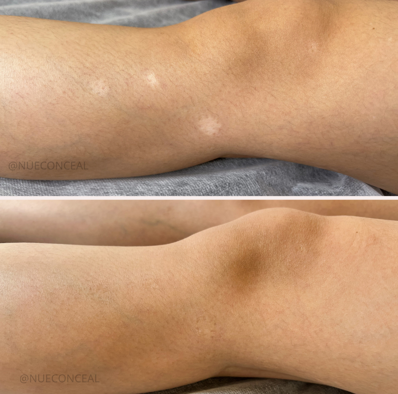 Leg before-and-after photo showing lighter skin patches diminishing, likely due to cosmetic treatment on the knee.