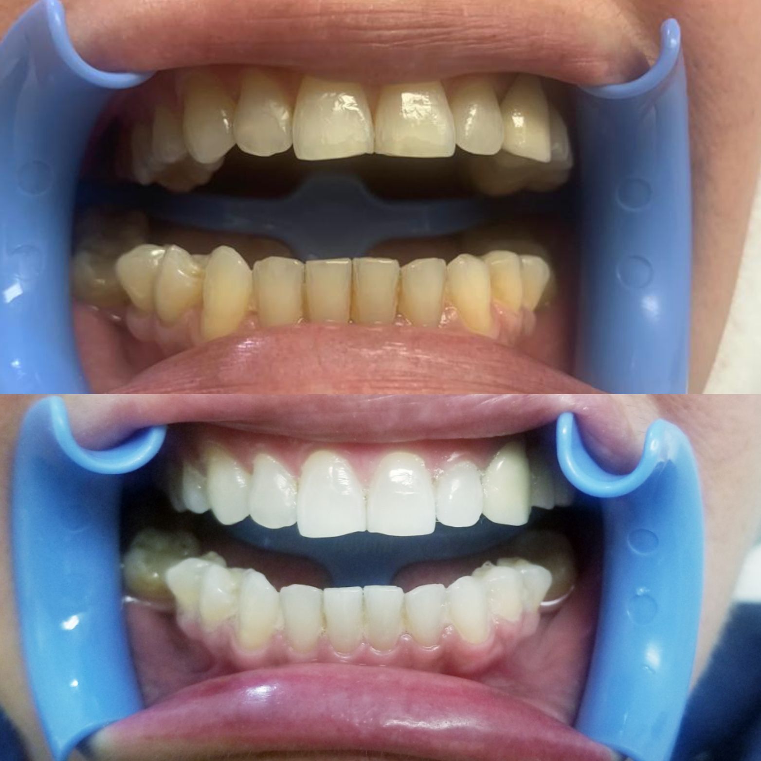 Teeth whitening before and after: Top row yellow teeth, bottom row white teeth, held open with blue retractors.