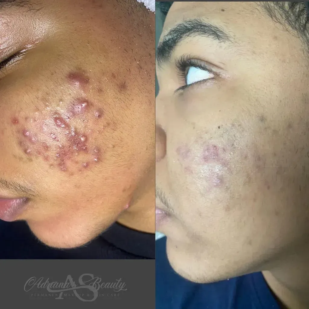 Before and after acne treatment on a person's cheek, showing improvement in skin condition.