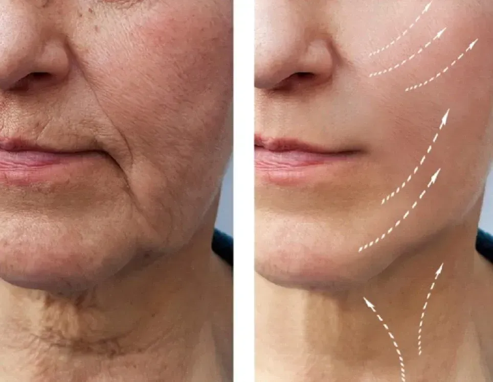 Before-and-after comparison: A woman's face with wrinkles before, and a smooth, tightened jawline after treatment.