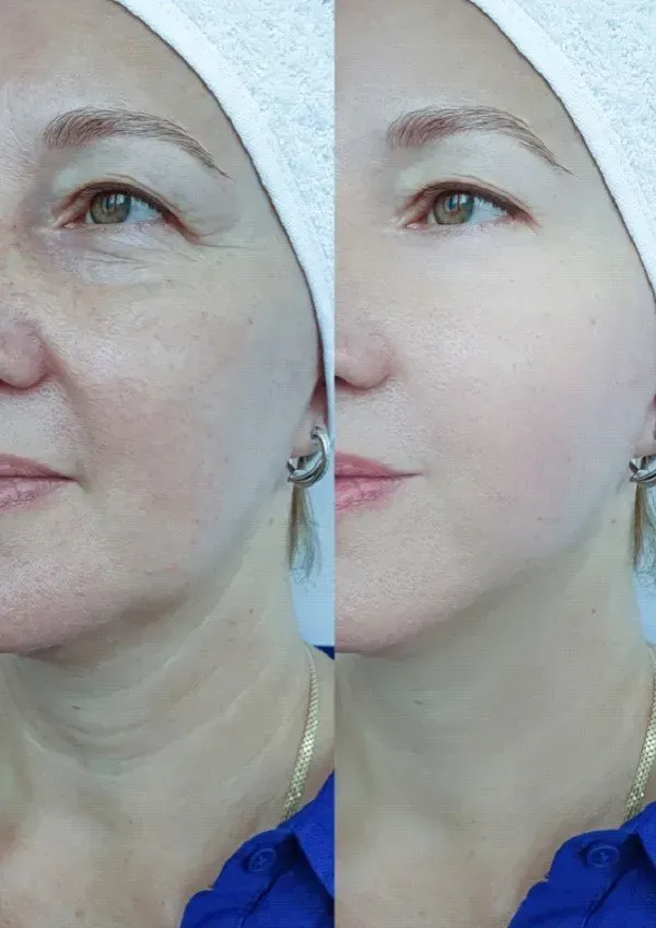Before and after facial photo; woman with wrinkles on the left, smoother skin on the right, wearing a towel.