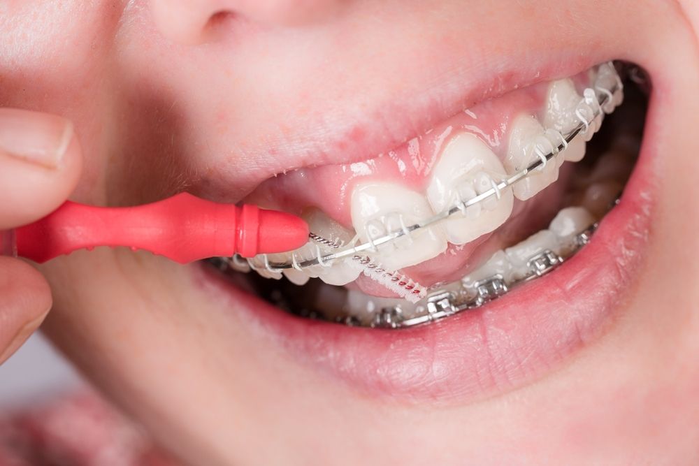 Can Braces Cause Gum Recession?