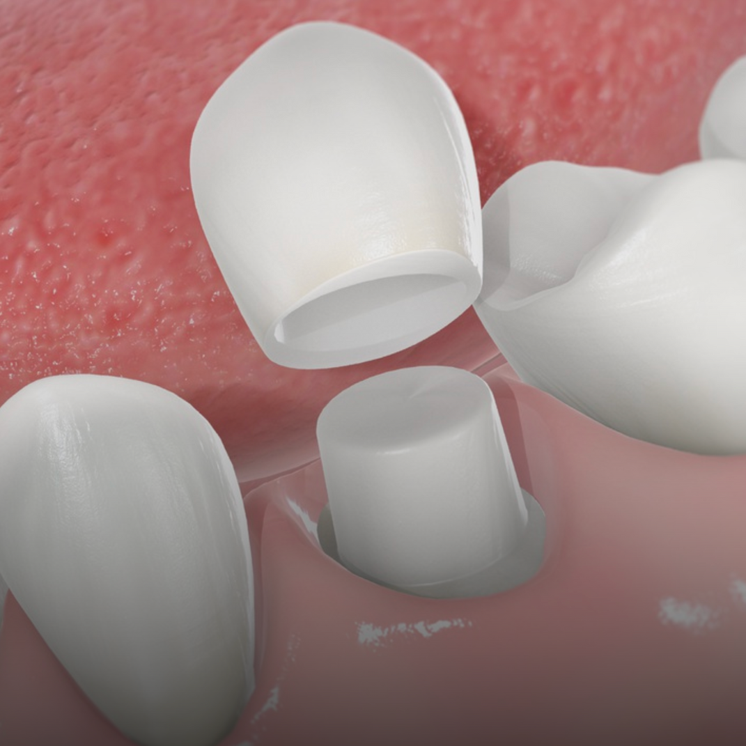 A close up of a tooth with a crown on it.