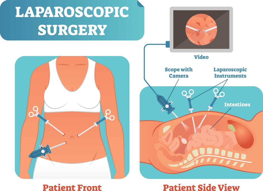 illustrazione sulla laparoscopia