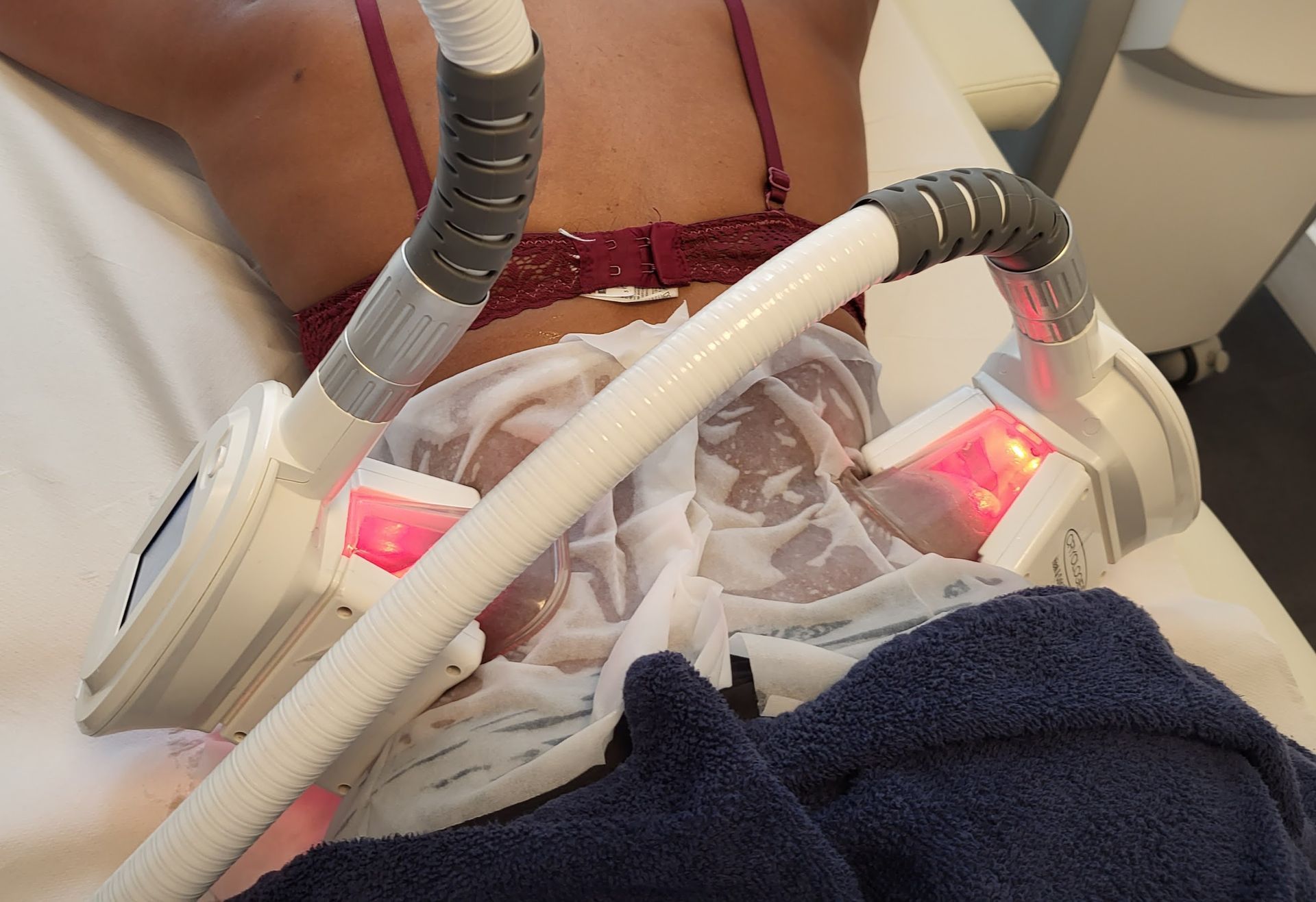 cryolipolyse poignée d'amour tours