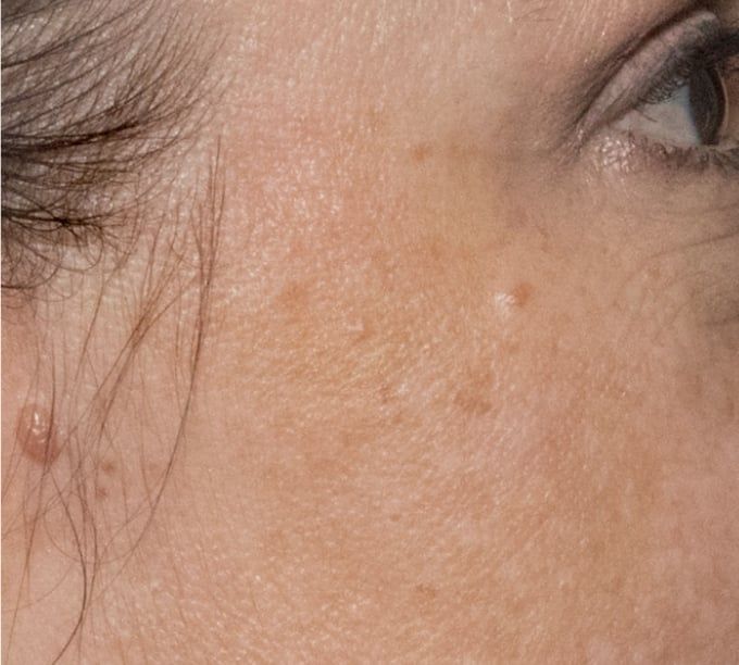 A close up of a woman 's face with clearer skin  Glacial RX