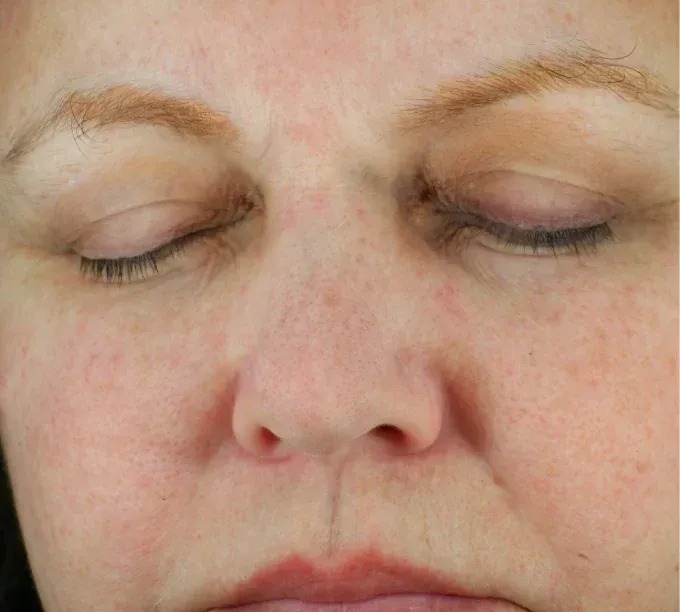 A close up of a woman 's face with her eyes closed and healthier skin after  Glacial RX