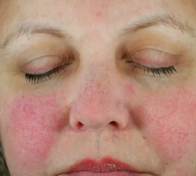 A close up of a woman 's face with her eyes closed and red cheeks  before Glacial RX