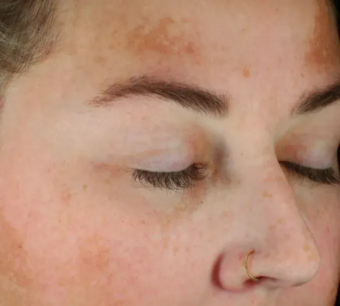 A close up of a woman 's face with her eyes closed before  Glacial RX