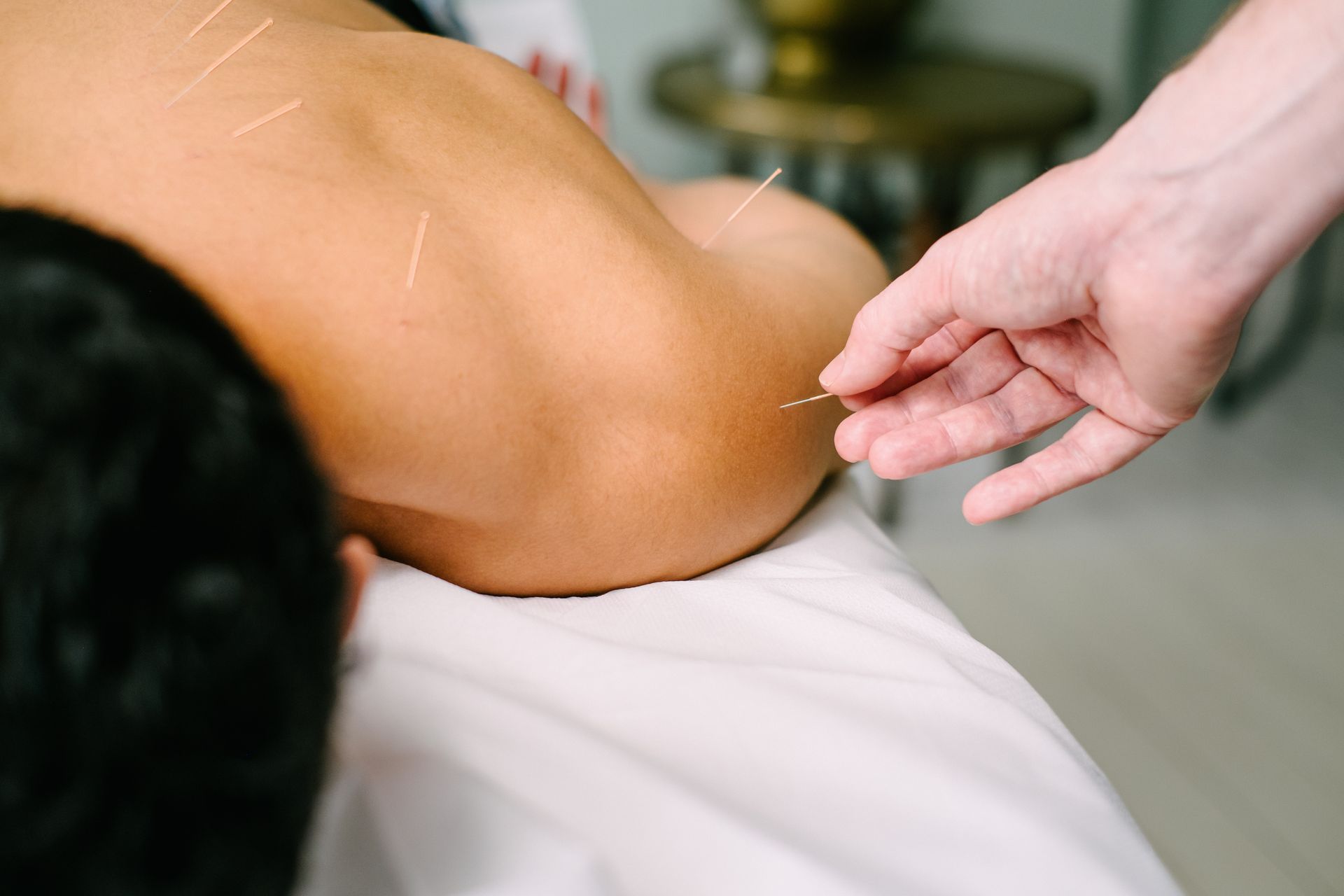 Person receiving acupuncture treatment on their shoulder. Needles inserted, therapist's hand near.