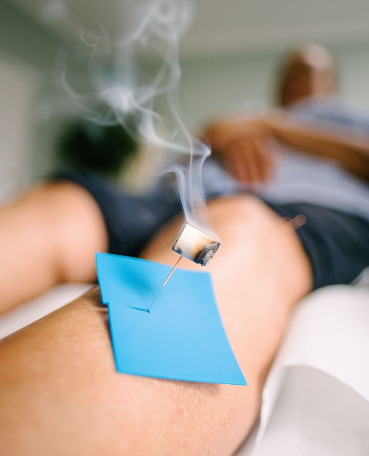 Acupuncture treatment: A burning moxa cone sits atop a needle on a patient's leg, emitting smoke.