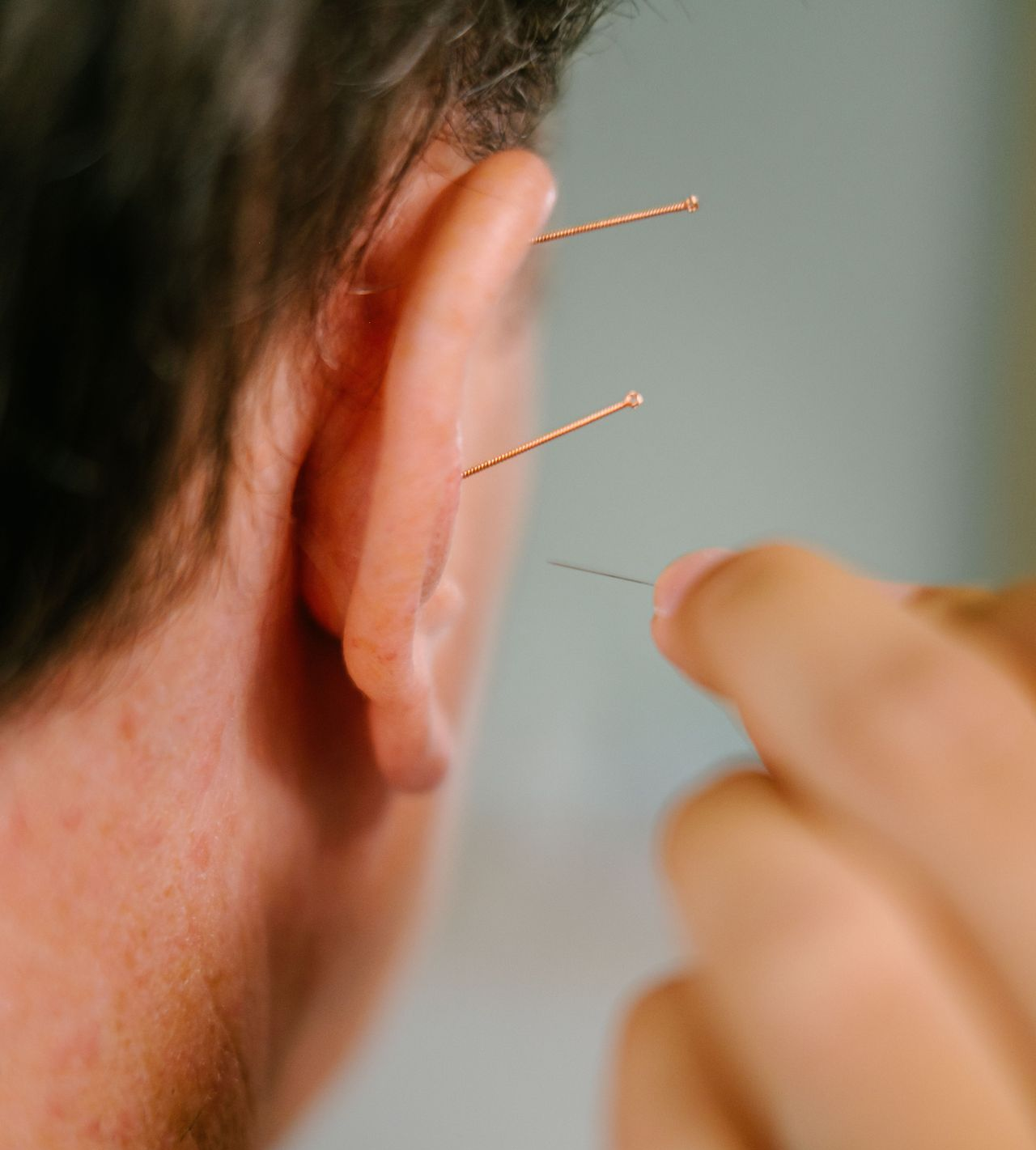 Person's ear with acupuncture needles inserted. Hand with needle ready to insert.