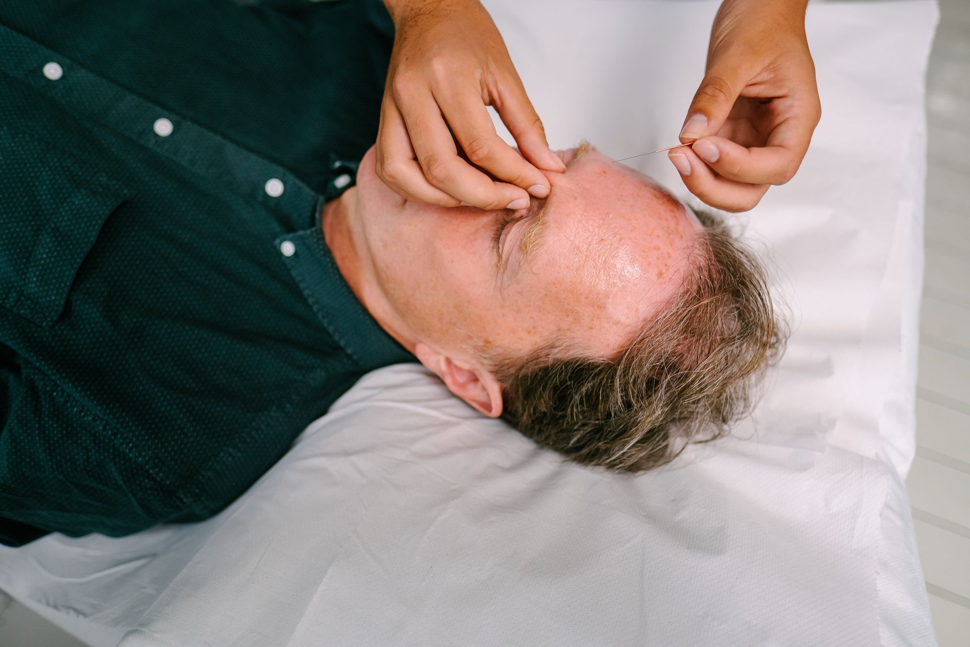 An acupuncturist is placing a thin needle into an extra acupuncture point called Yintang to help calm the mind.