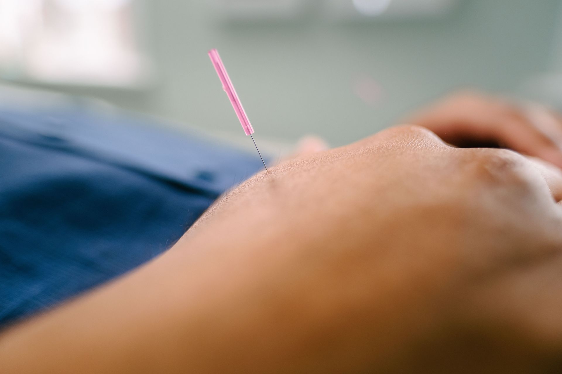A close-up of a patient with a common acupuncture point, Large Intestine 4 or He Gu, which has a needle in it.
