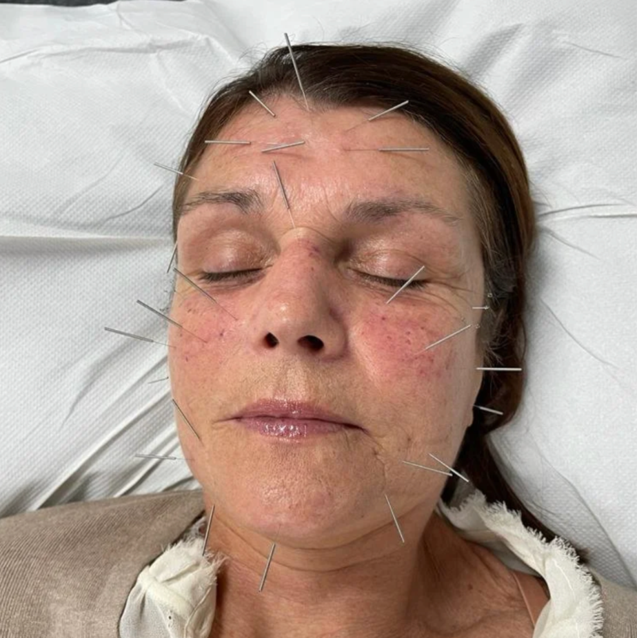 Woman with acupuncture needles in her face, lying down, eyes closed.
