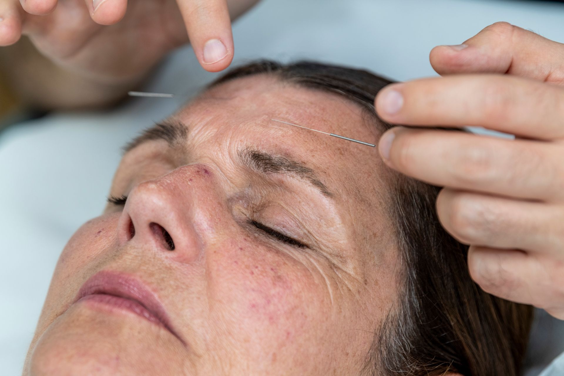 Woman receiving acupuncture on her forehead. Needles are inserted, eyes closed.