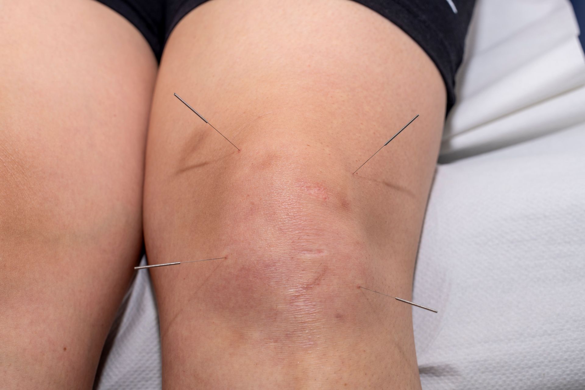 A knee with acupuncture needles inserted.