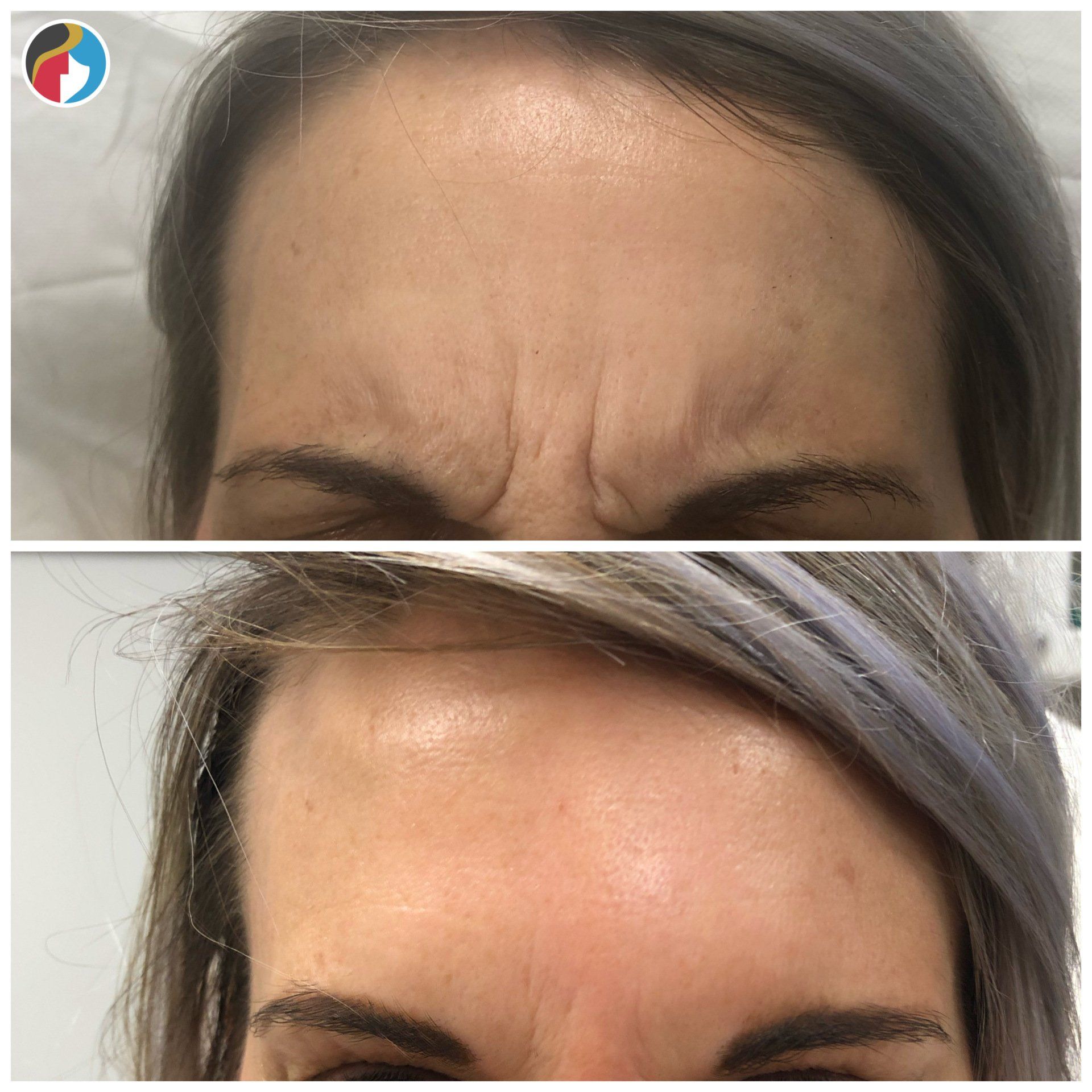 Botox improves fine lines and wrinkles, available in Syracuse 