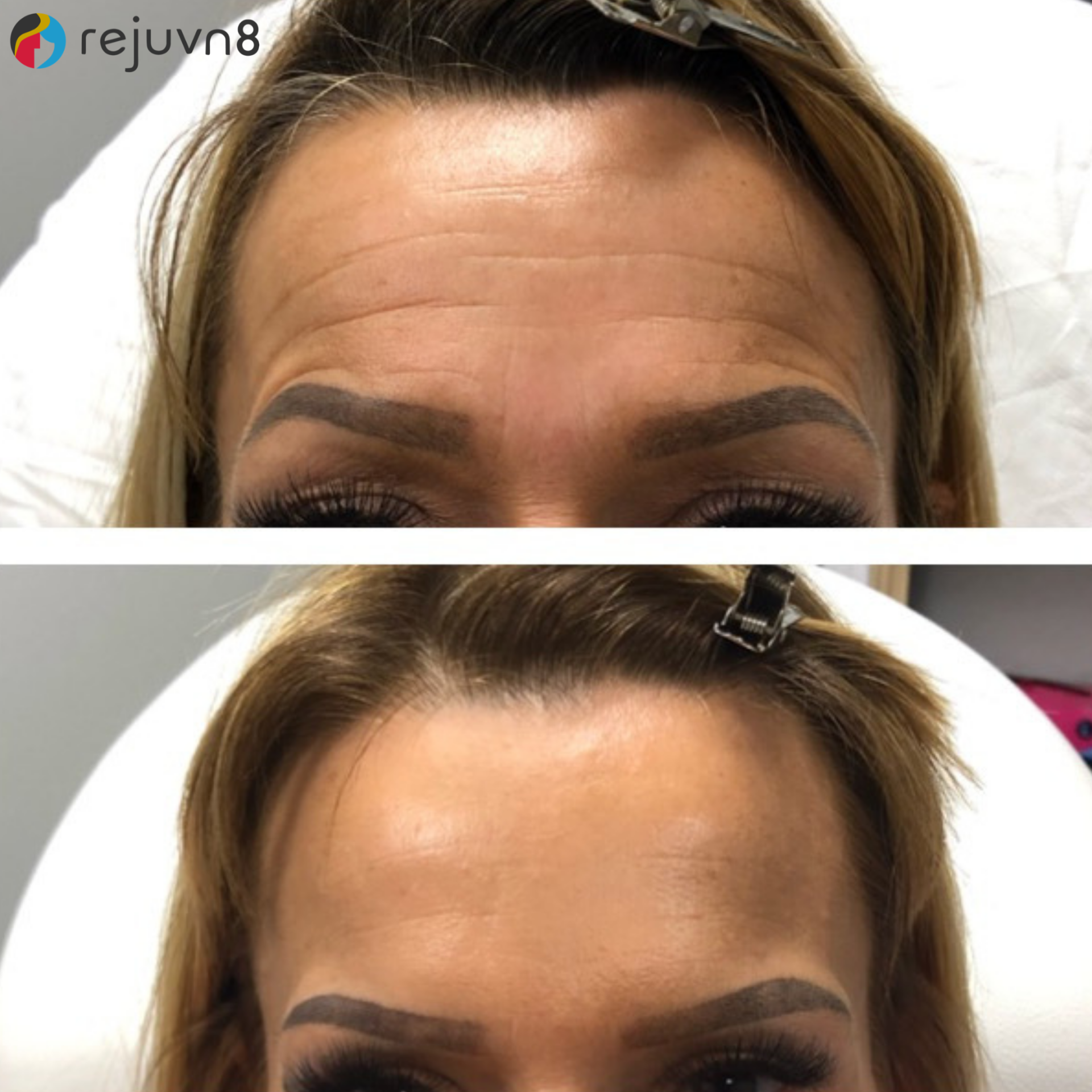Before and after botox in Syracuse- less wrinkles 